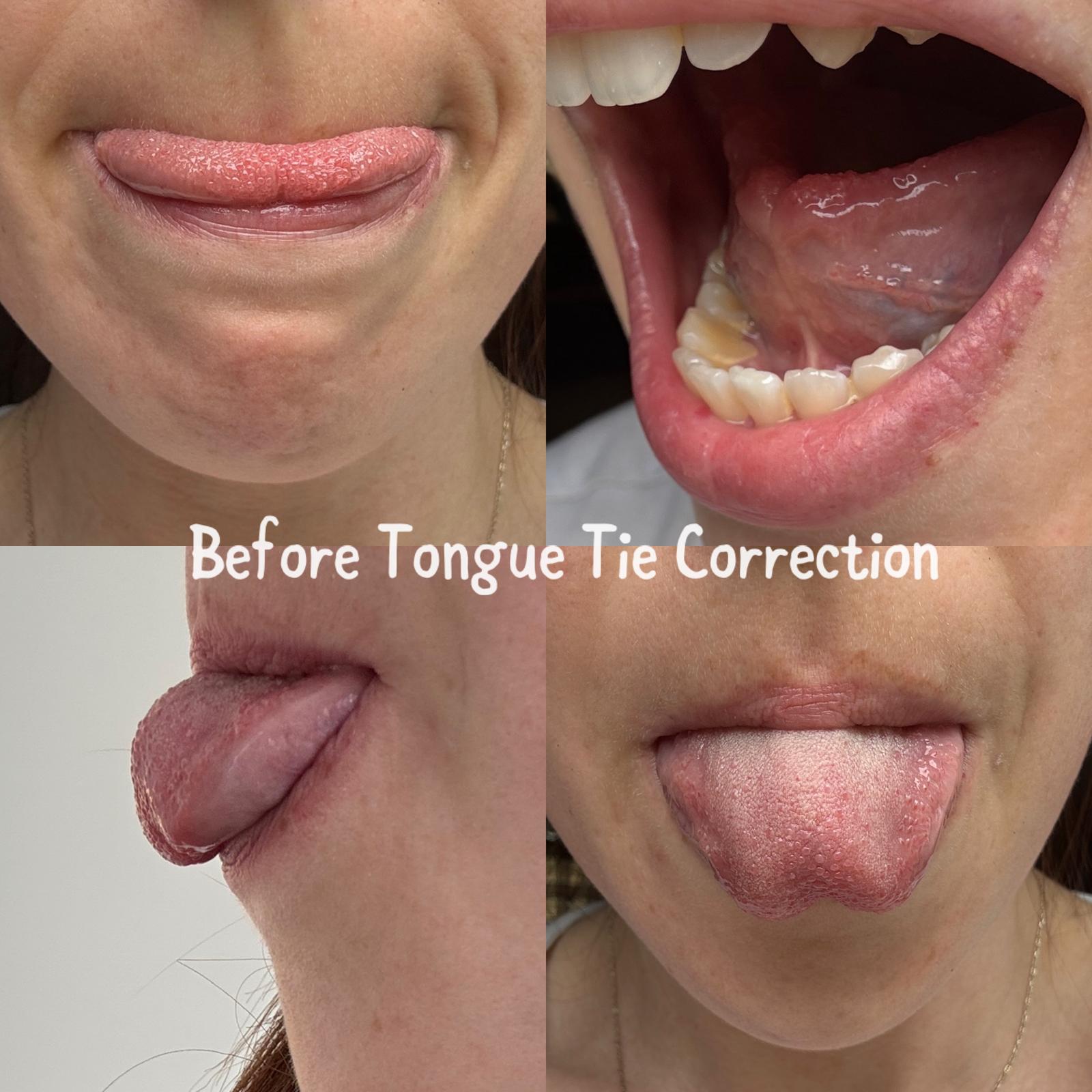 Does Tongue-Tie Always Need Treatment? A Guide for Parents and Adults