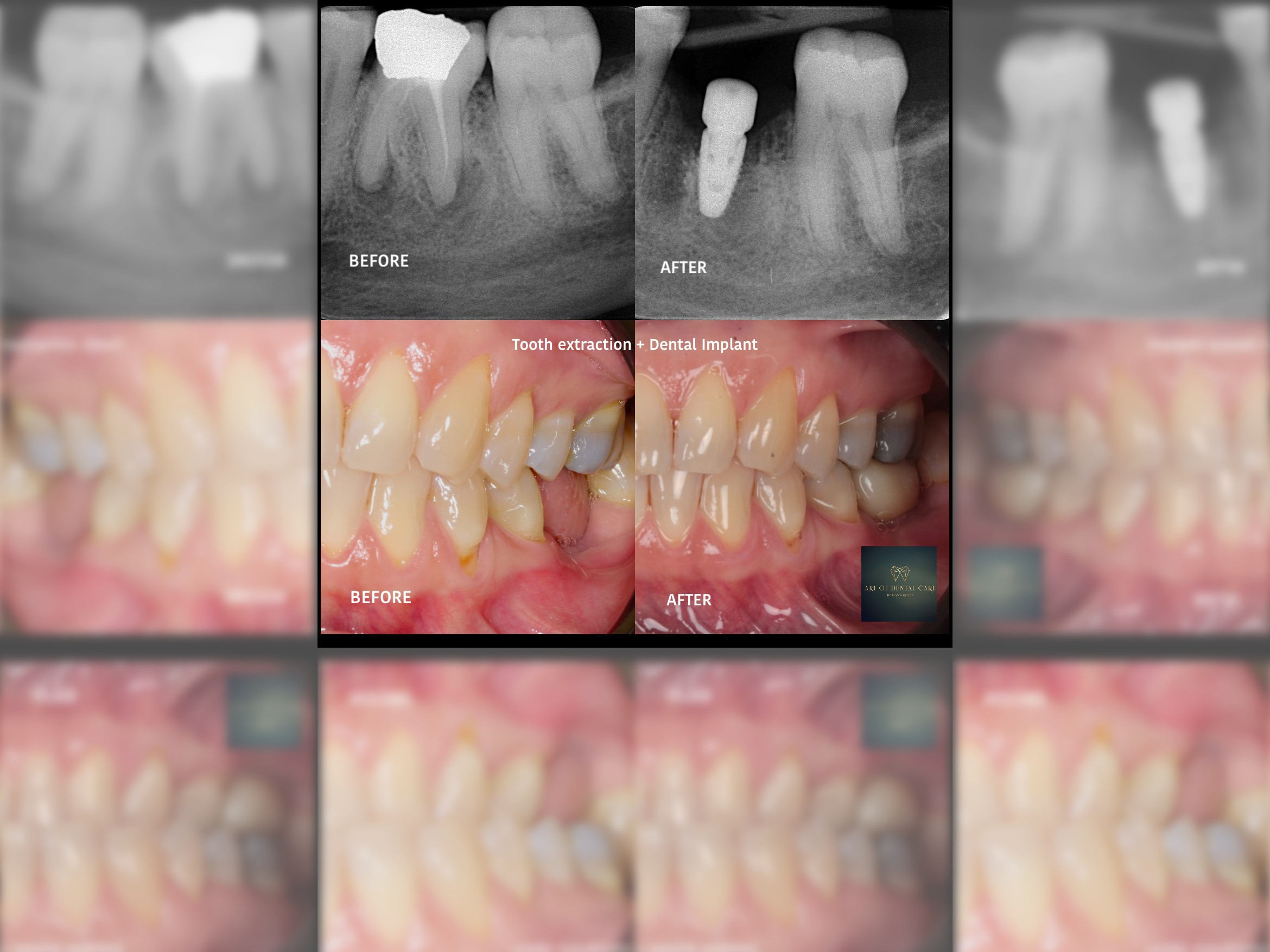 Guided Dental Implant Surgery: Does Digital Planning Make Implant Placement More Accurate?