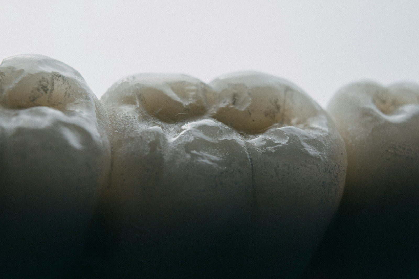 ICON Treatment for White Spots on Teeth: A Minimally Invasive Solution
