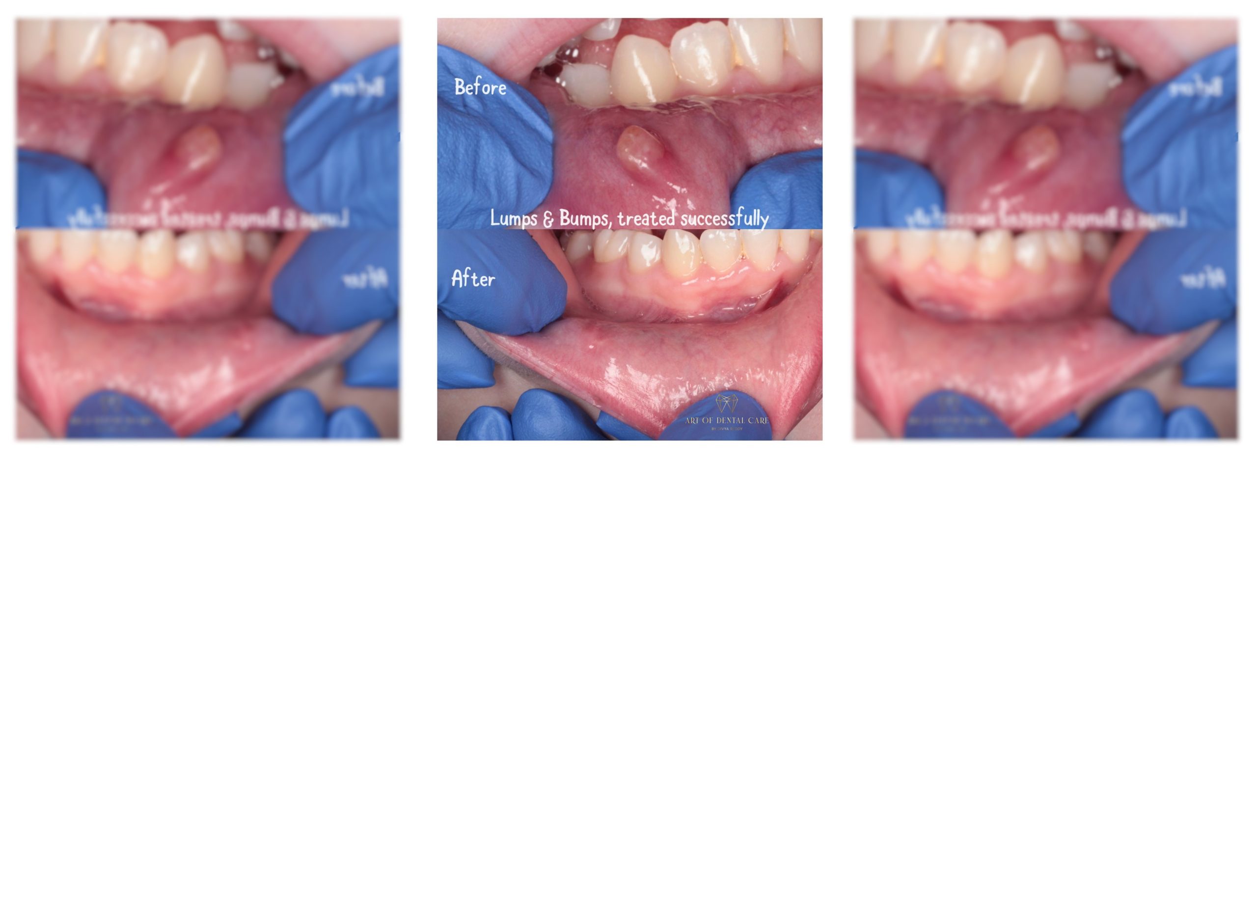 Lumps and Bumps in the Mouth: What Are They and When Should You Be Concerned?